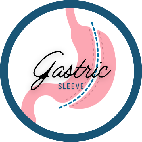 Gastric Sleeve illustration